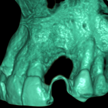 Registro de Implantes