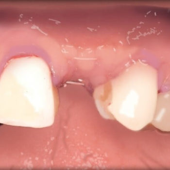 Registro de Implantes