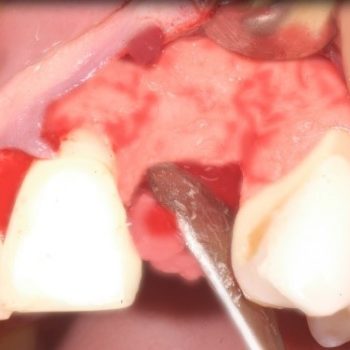 Registro de Implantes