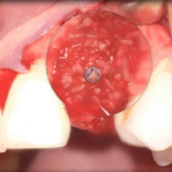 Registro de Implantes