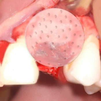 Registro de Implantes
